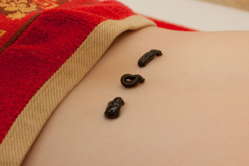 Sanguijuelas en la espalda baja con osteocondrosis. 