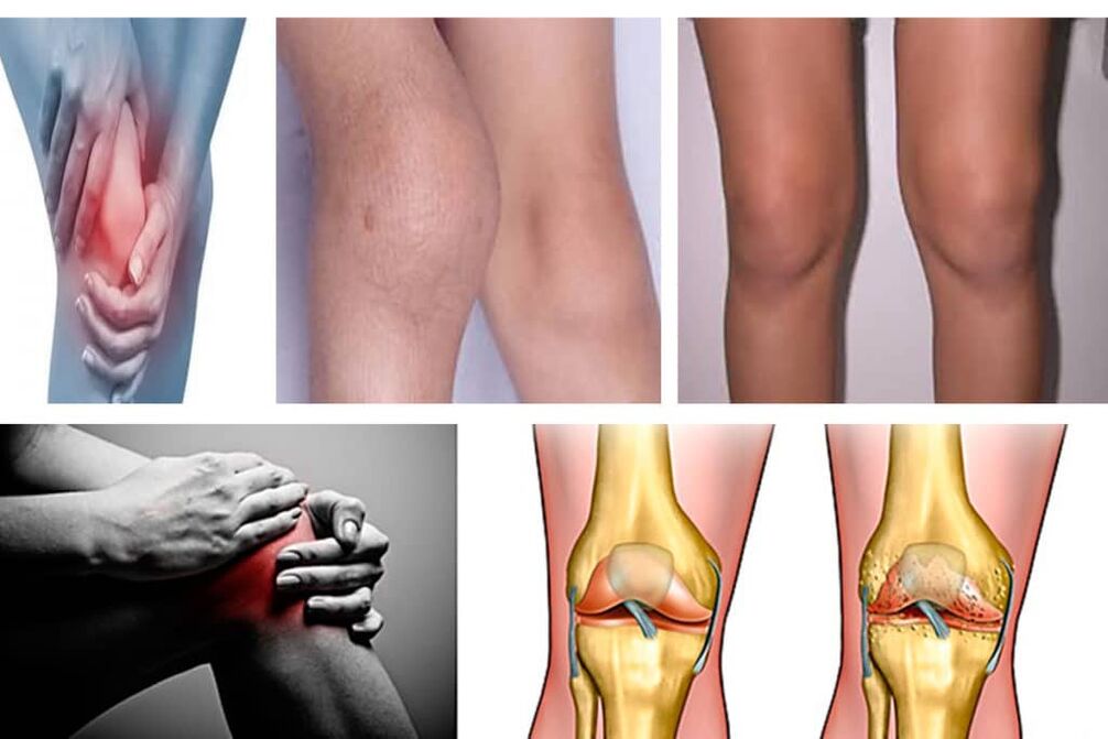 Síntomas de la osteoartritis de la rodilla